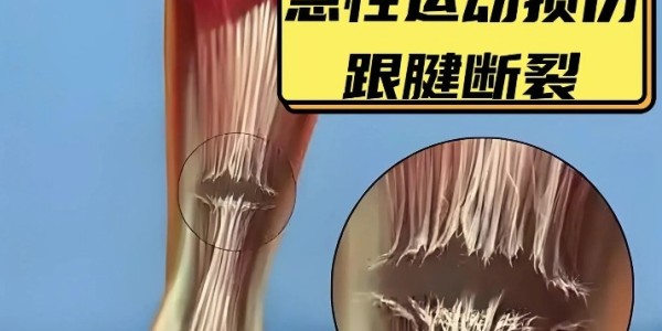 10个月康复已算快！跟腱撕裂为什么是竞技体育的“阿喀琉斯之踵”